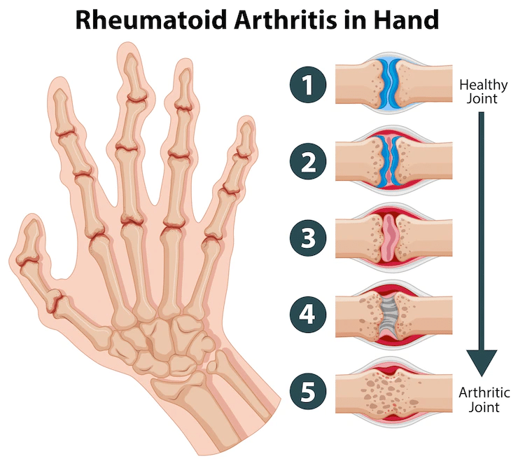 โรคข้ออักเสบ (Arthritis)