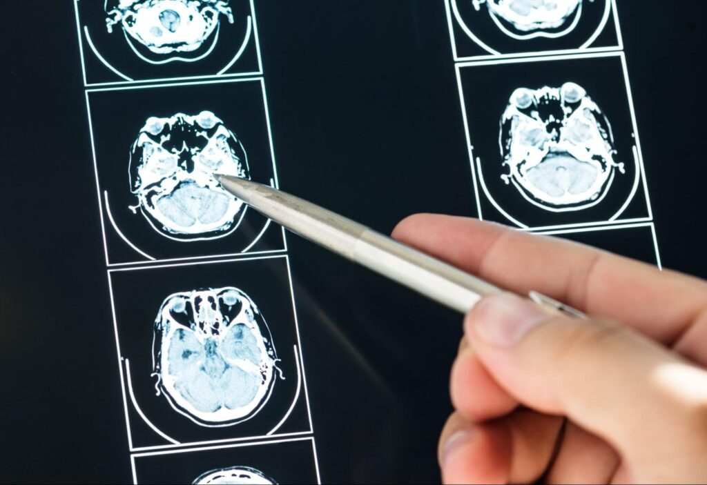 treatment of Brain Tumor